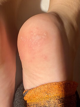 Really small bubbles going deep into skin spreading quickly (2months). No fungus, also antibiotics did not help