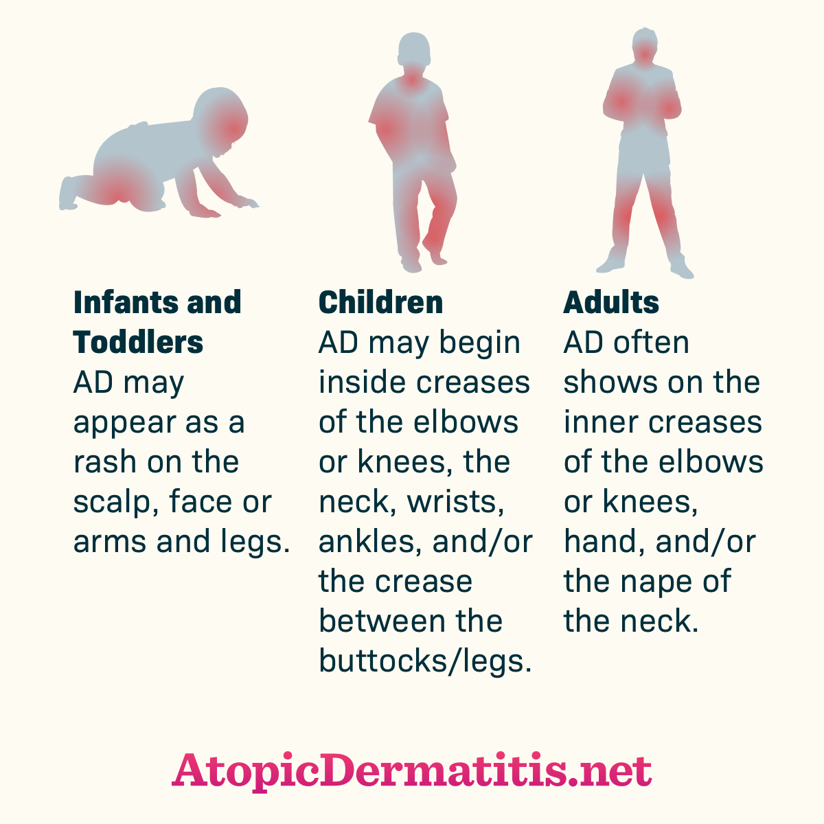 Atopic dermatitis rash locations differ between infants and toddlers, children, and adults
