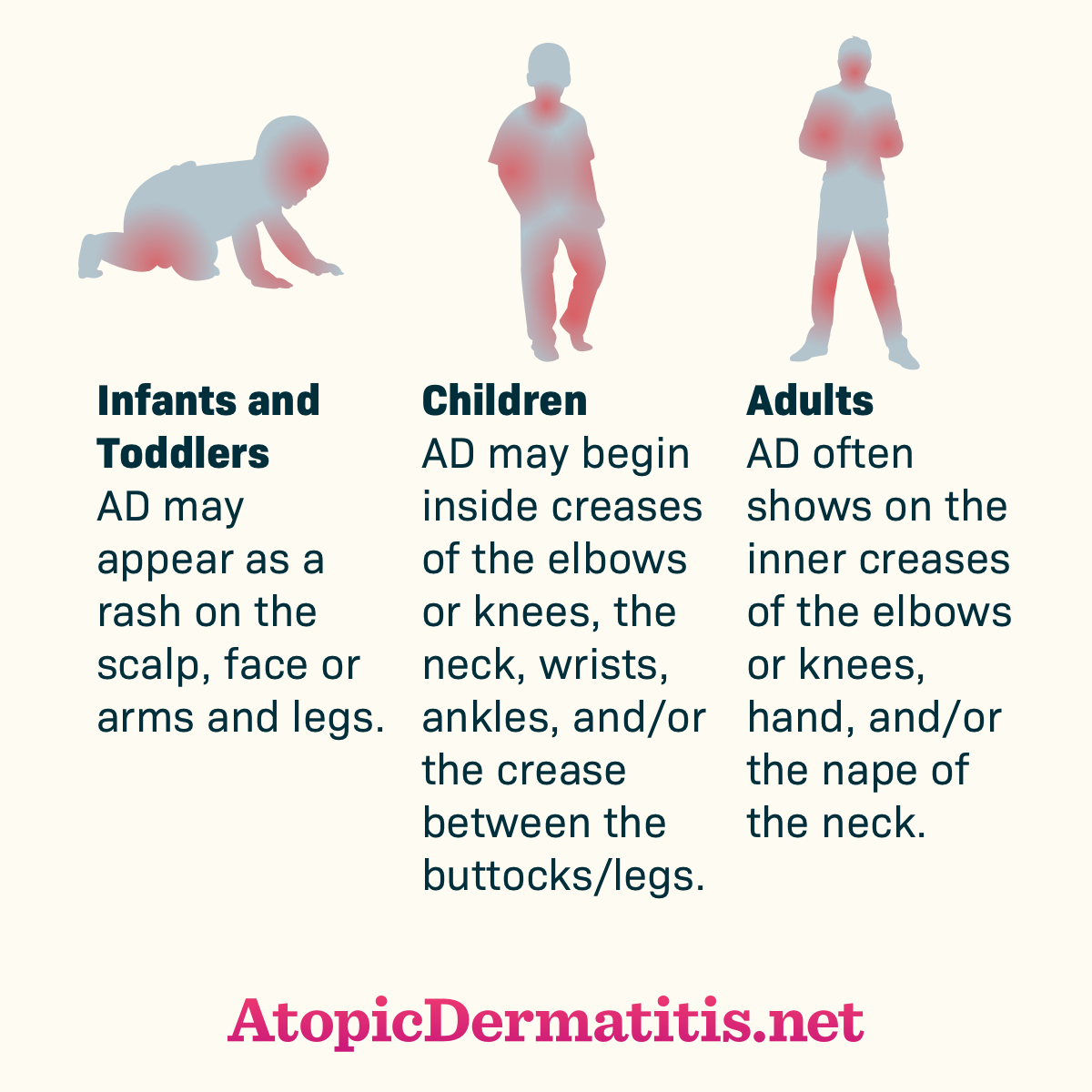 Childhood Eczema Distribution