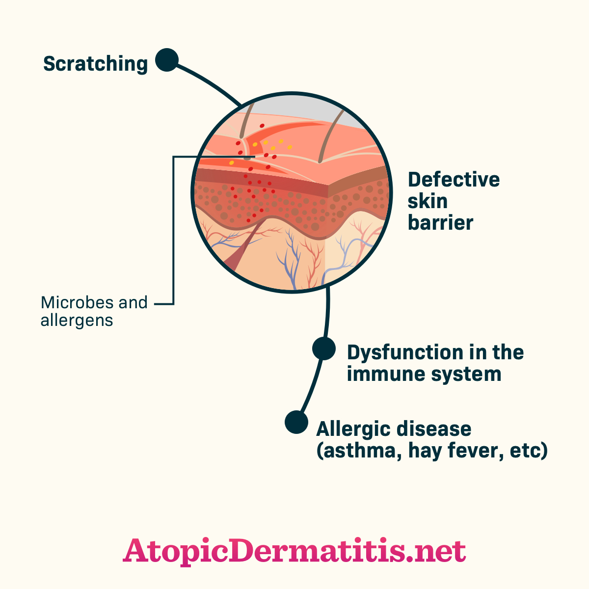 What Is The Itch Scratch Cycle Atopicdermatitis Net