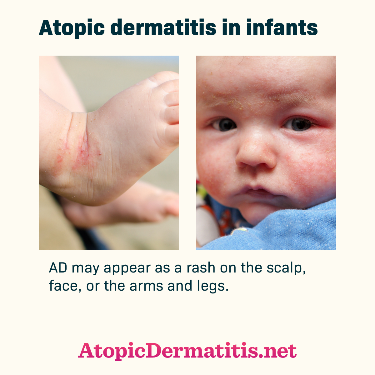 Infant with atopic dermatitis rash on foot and face