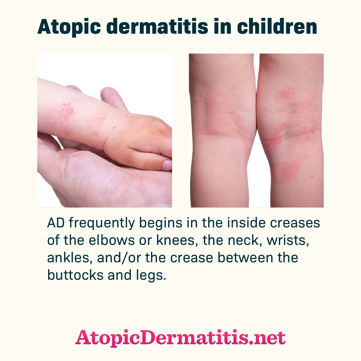 Child with atopic dermatitis rash on arm and on the back of the knees