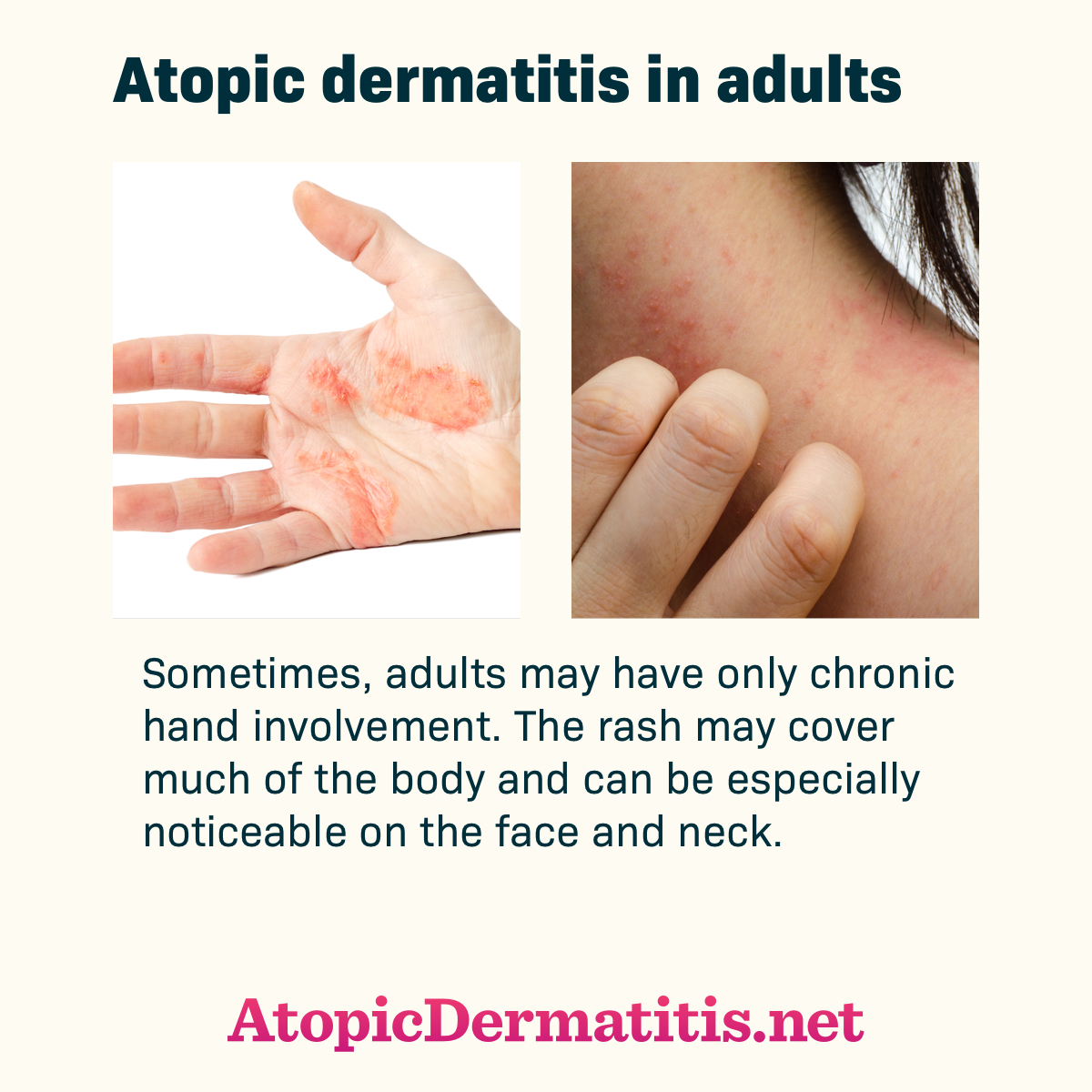 Atopic Dermatitis Face Treatment Doctor Heck 