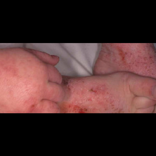 Atopic dermatitis rash on young child's hands and feet