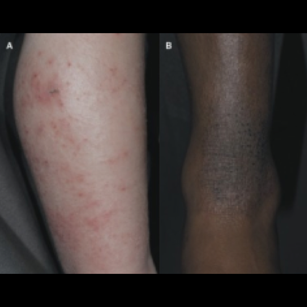 Commonly affected areas in children