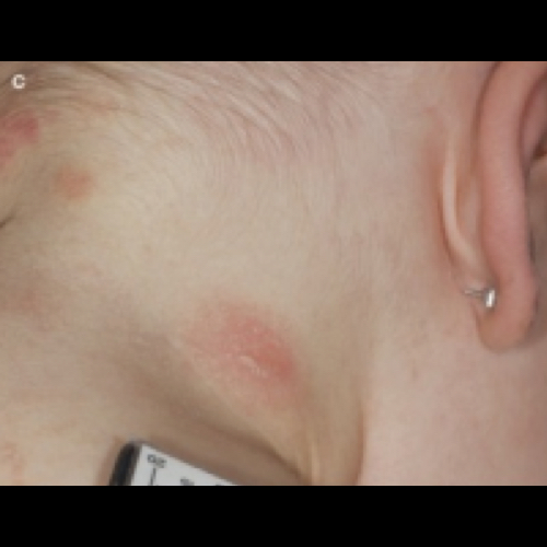 Red bumps on young child's neck