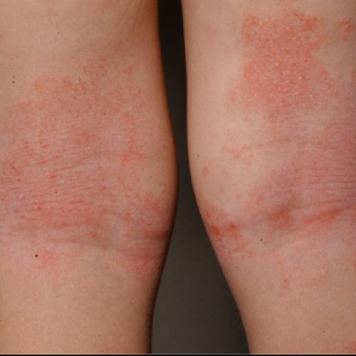 Atopic dermatitis rash on back of child's knees
