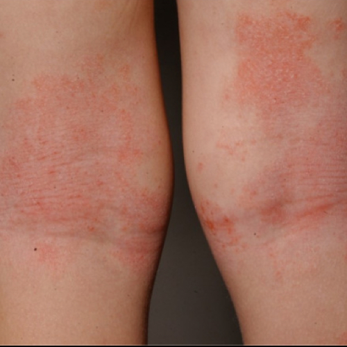 Atopic Dermatitis In Children Image Gallery