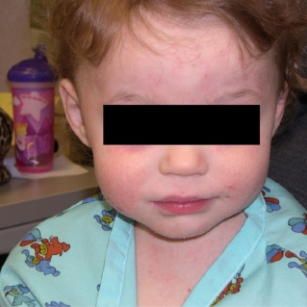 Atopic dermatitis in children