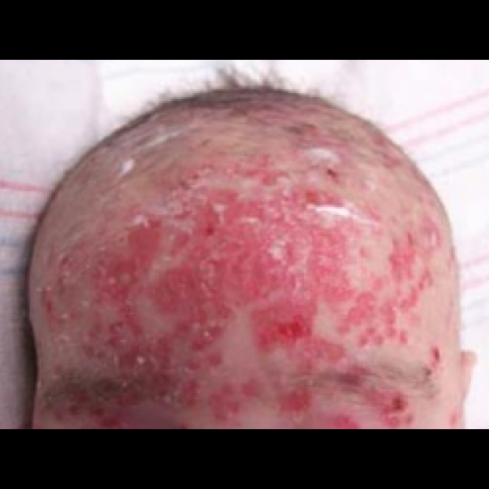 Complications of atopic dermatitis