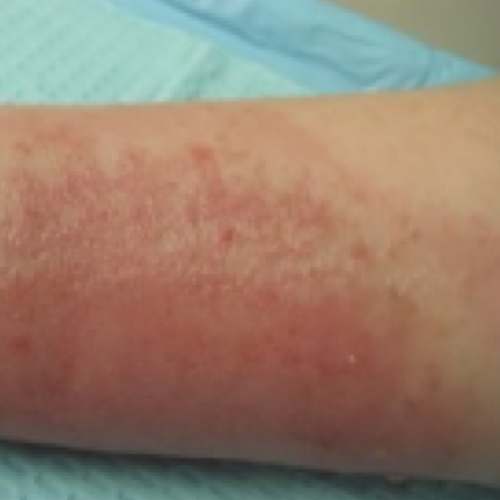 Red rash on arm