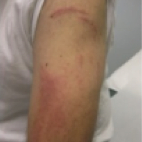 Contact Dermatitis