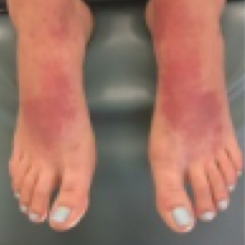 Contact Dermatitis