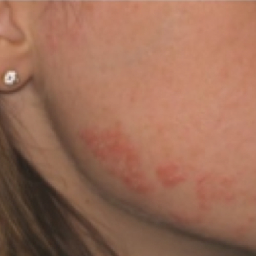 Red rash on face