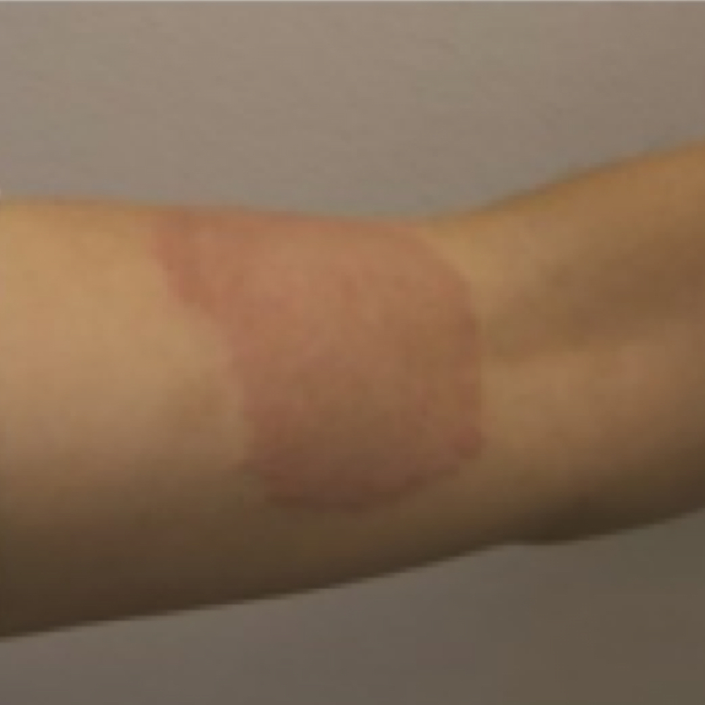 Contact Dermatitis