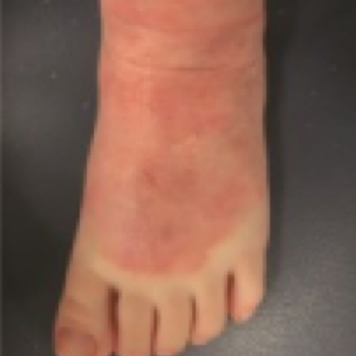 Contact Dermatitis