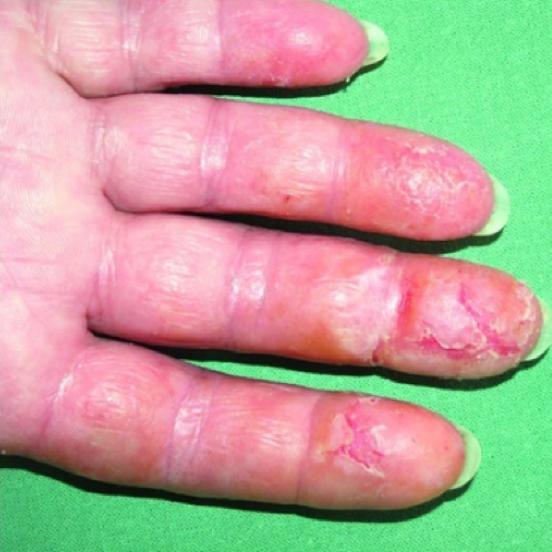 Cracked skin on fingertips