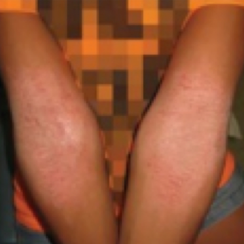 Changes in Skin Color