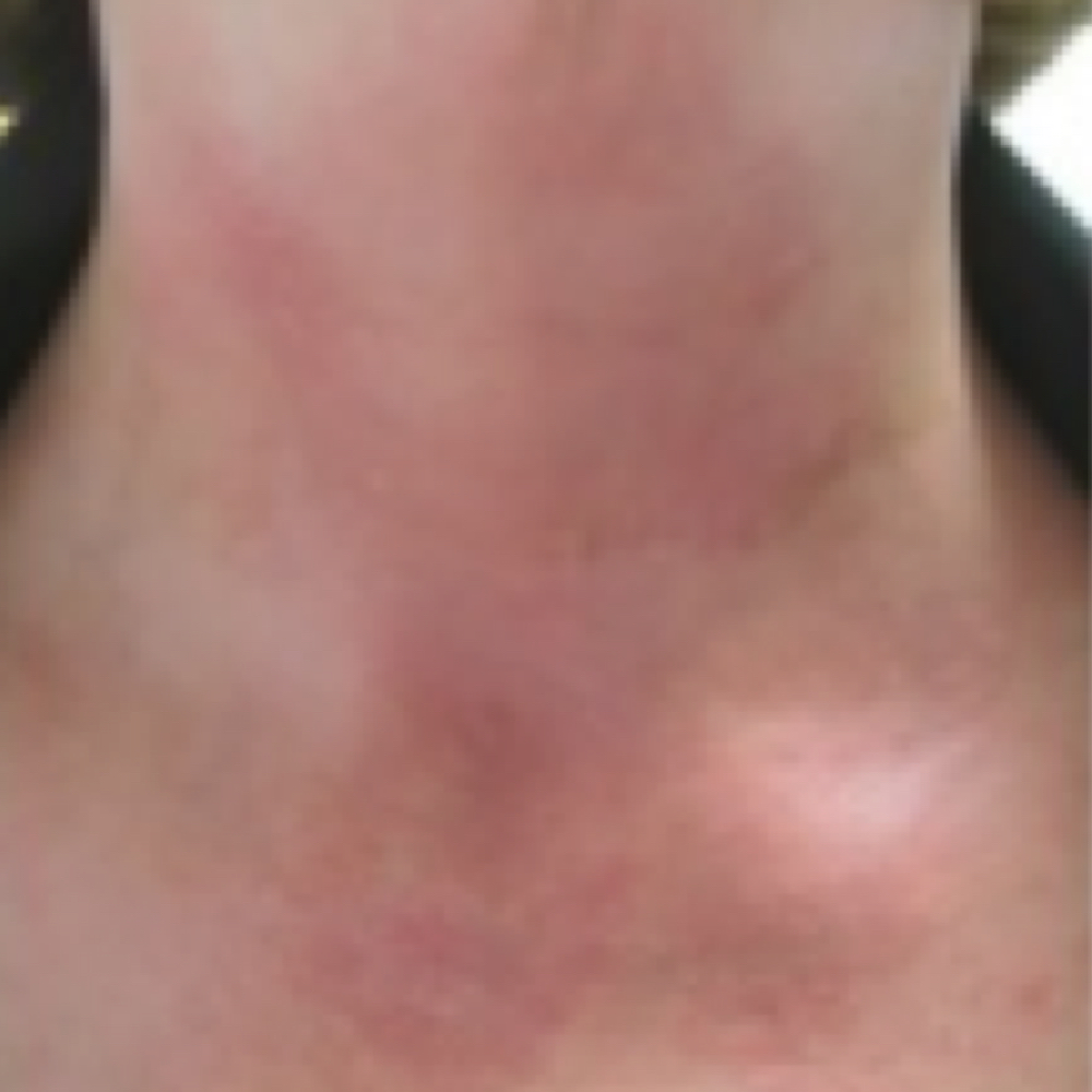 Erythroderma