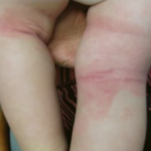 Baby legs with red patches on back of knees