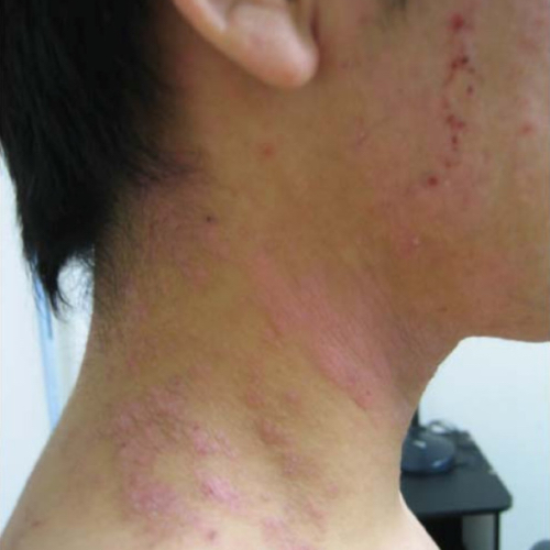 Atopic dermatitis rash on face and neck