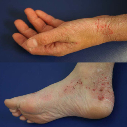 Hand and foot with eczema rashes