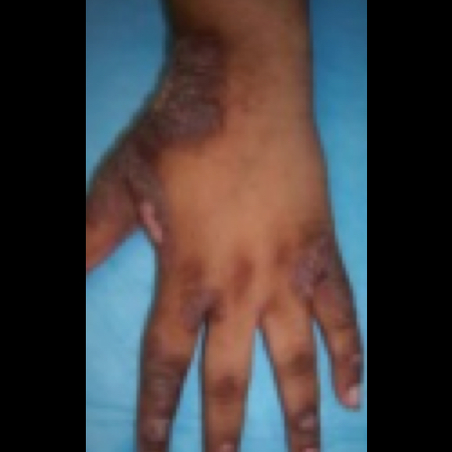 Adult hand with thickened skin and dark patches