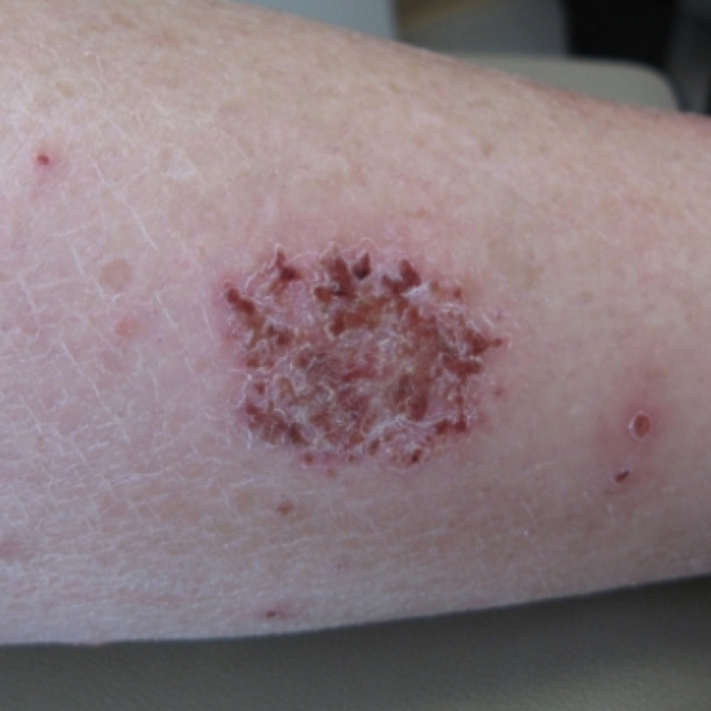 Nummular eczema