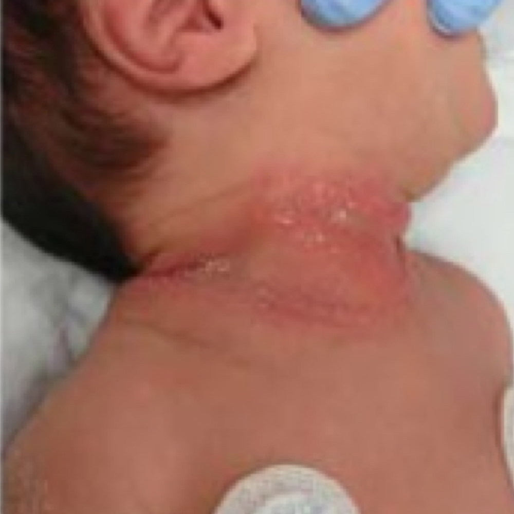 Seborrheic dermatitis