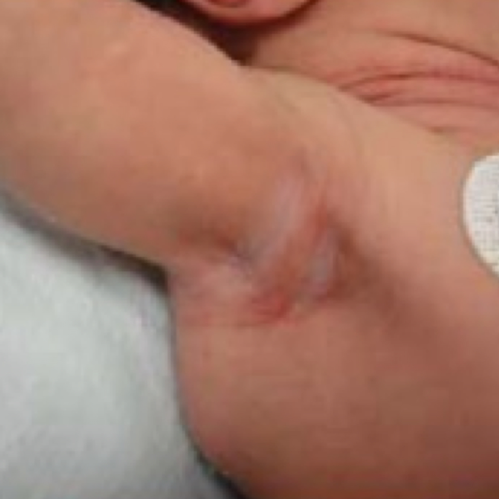 Seborrheic dermatitis
