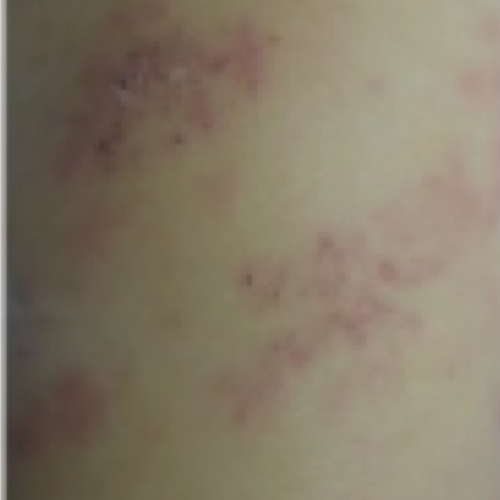 Patch of skin with small red bumps
