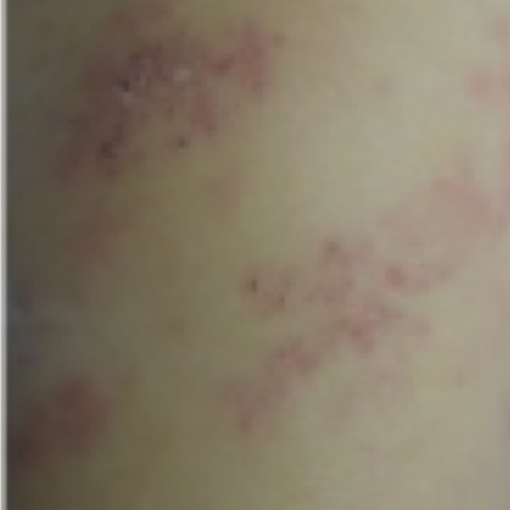 Papules (Skin Lesions)