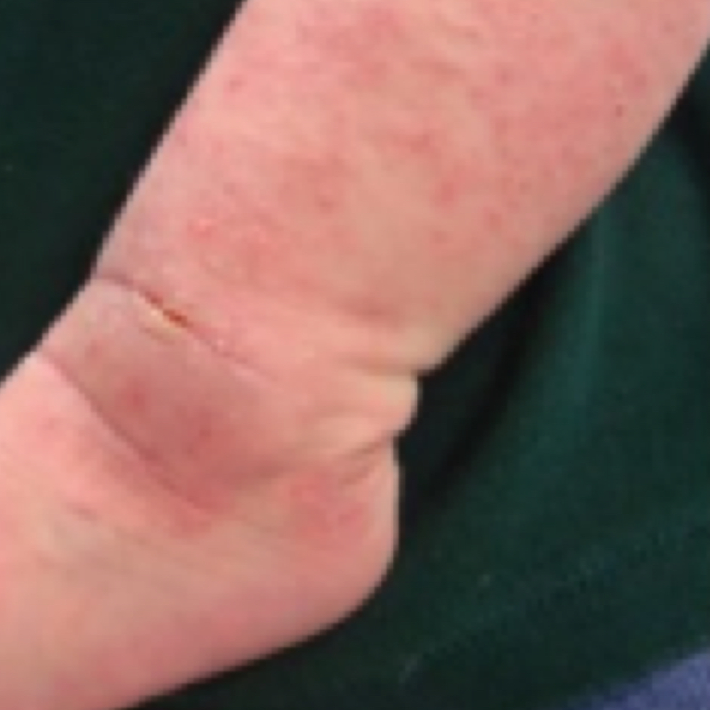 Papules (Skin Lesions)