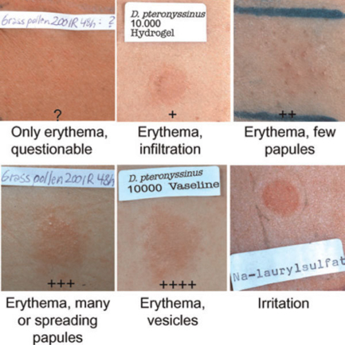 Patch test showing erythema and irritation on skin