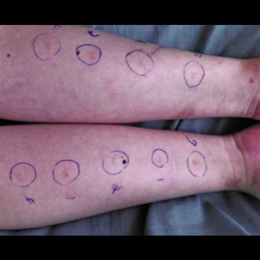 Skin Prick Test