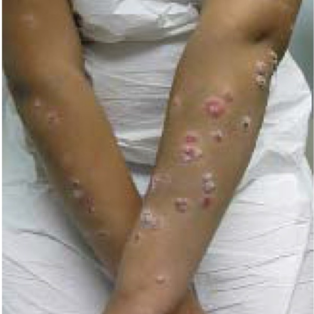 Psoriasis