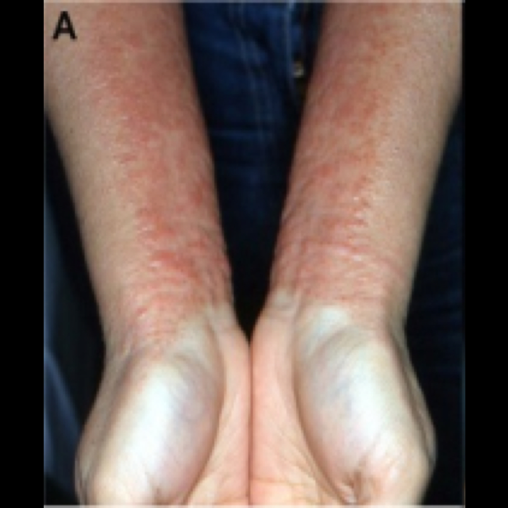Red, inflamed rash on arms