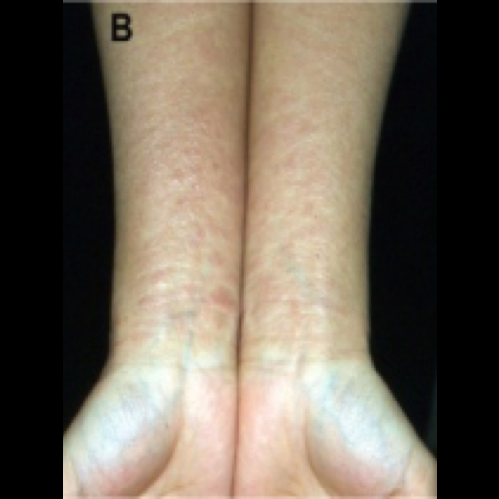 Topical Steroid Withdrawl (Red Skin Syndrome)