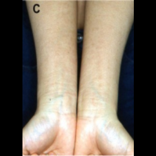 Topical Steroid Withdrawl (Red Skin Syndrome)