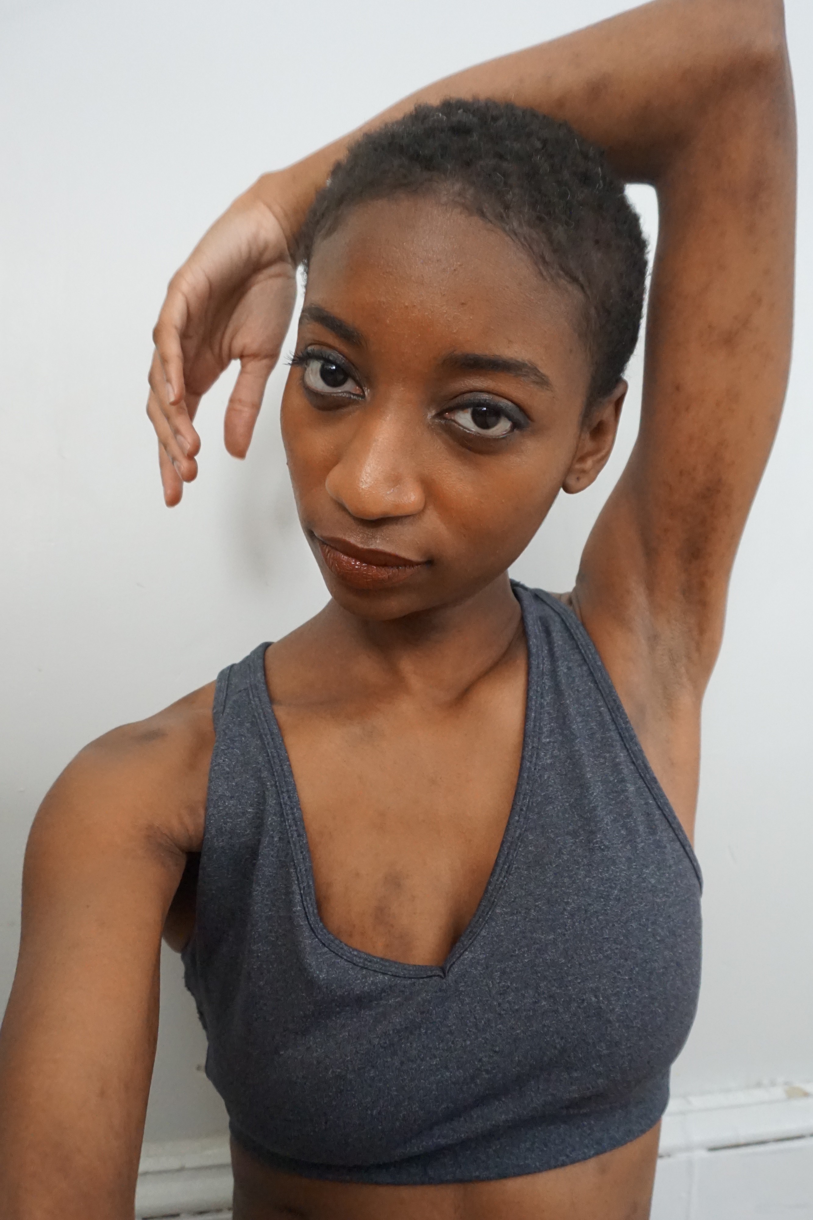 Short haired Raelle poses showing eczema on arms and torso