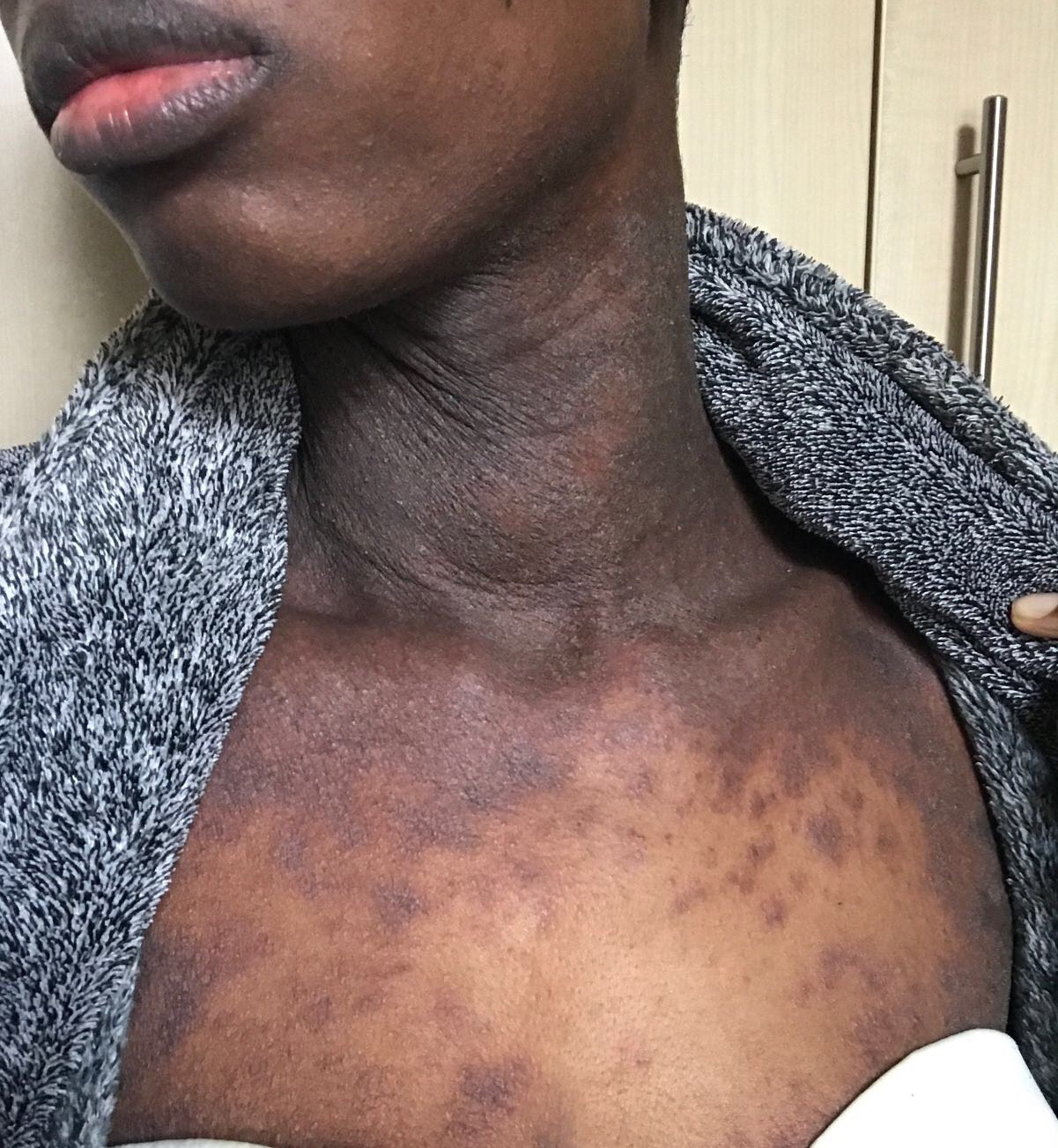 Eczema rash on Joanne's neck