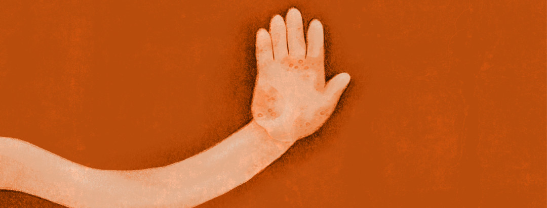 A hand with eczema is holding up 5 fingers for the 5 worst eczema locations.