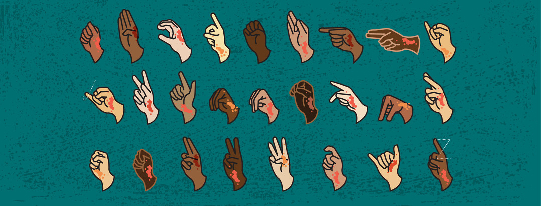 Hands, showing eczema lesions, are signing the alphabet