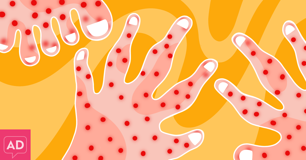 Pomplex My Pompholyx (Dyshidrotic Eczema) Experience