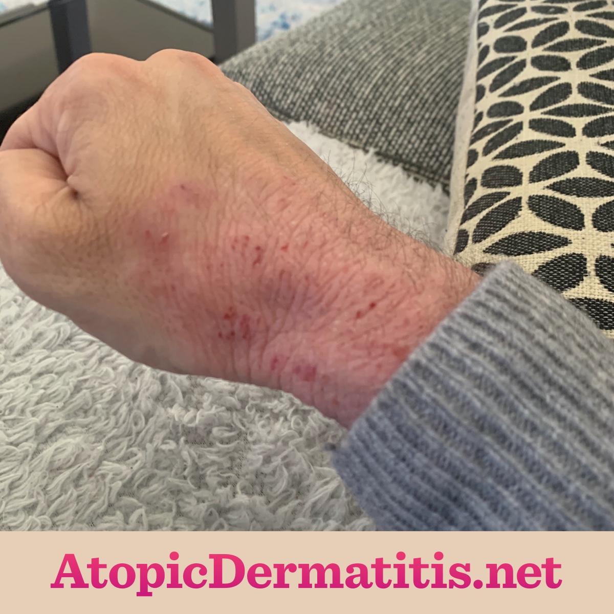 mild eczema on wrist