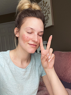 Briana Banos with a soft smile and closed eyes, doing a peace sign and turning her cheek toward the camera to show her facial eczema.