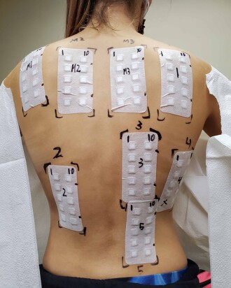 Woman with patches on her back for allergen testing