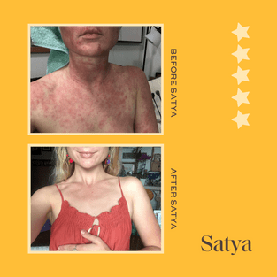 Before and after photo of rashy skin that is now smooth after using Satya skincare