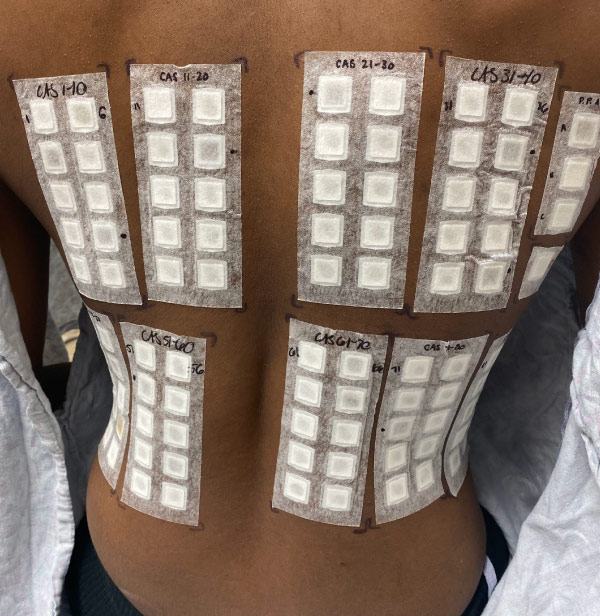 Picture of the chemical patch testing on the back of a person