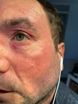 Photo of the left half of a man's face with widespread redness, a dark red mark under the eye, and a few raised spots across his skin. Eczema advocate Peter Bunting.